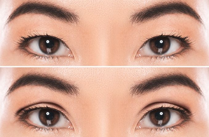 eyelid surgery deals nyc